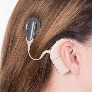 General Overview of the Cochlear Implant